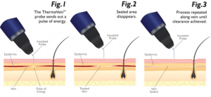 Explanation of how thermavein treatment is performed