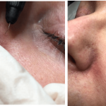 Carly perfomes Thermavein treatment to remove broken capillaries and red veins at the No.6 Clinic
