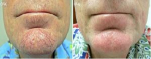 Thermavein treatment before and after on chin