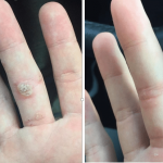 Thermavein treatment before and after on hand