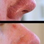 Thermavein treatment before and after on nose