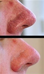 Thermavein treatment before and after on nose