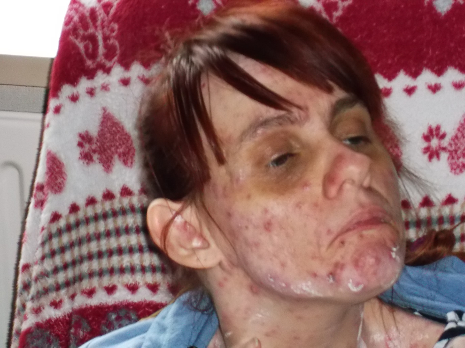 A photograph of a person with chicken pox