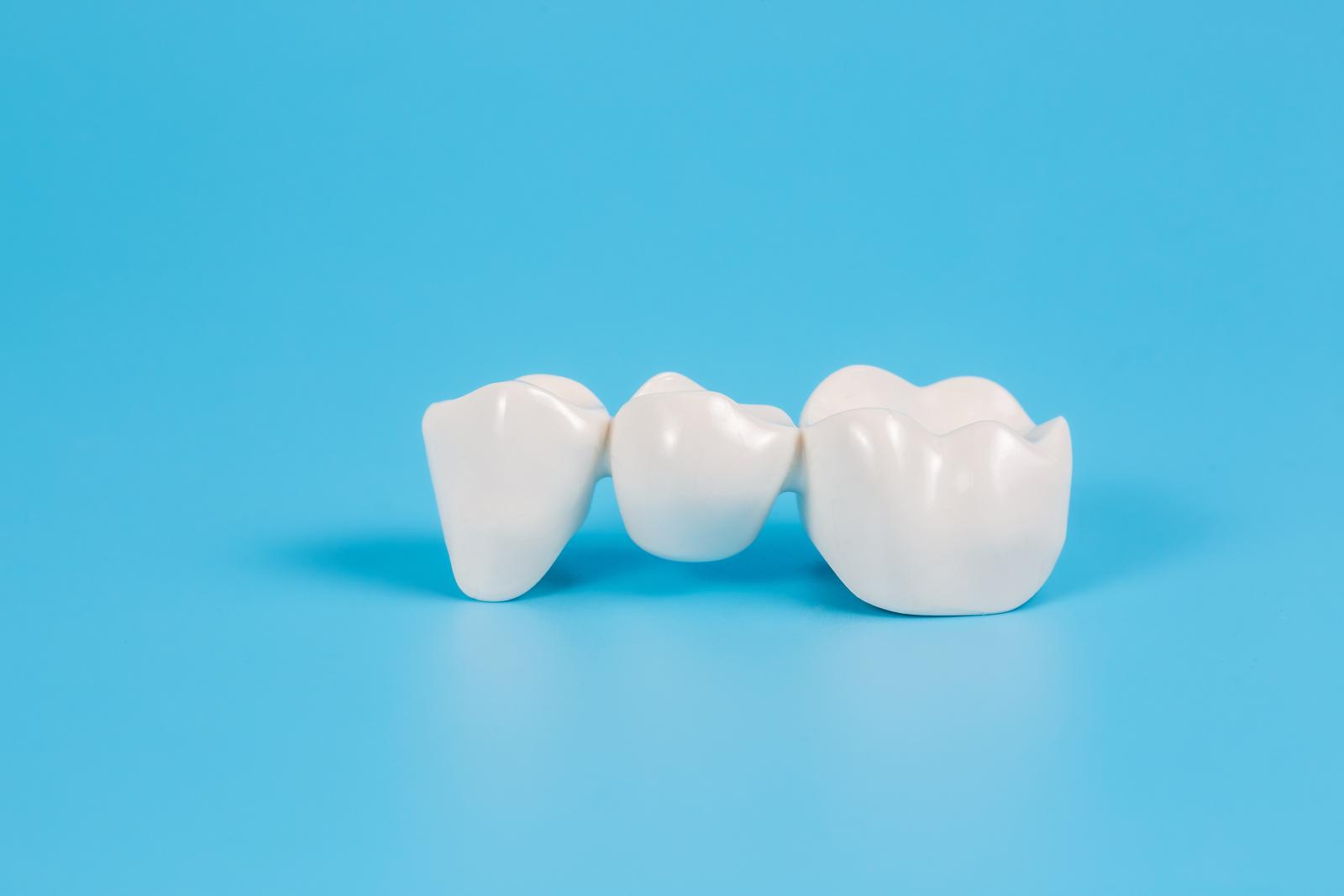 Koje su prednosti ugradnje zubne krunice?