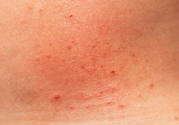 Causes of Skin Rash