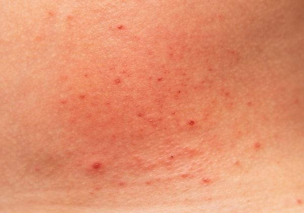 Types Of Skin Rashes - Immunity - 1MD