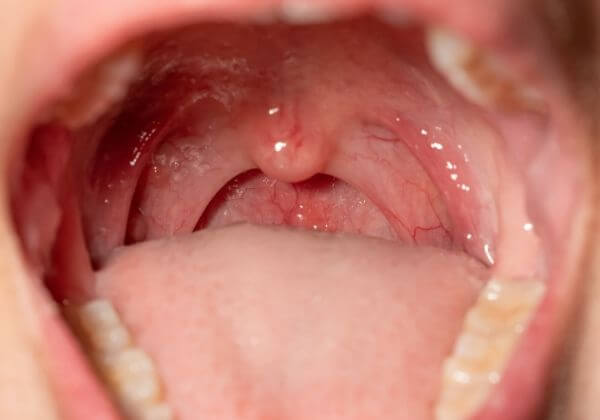 Red Spots On Roof Of Mouth - Immunity - 1MD