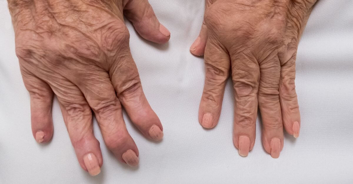 Causes and Natural Remedies for Rheumatoid Arthritis Linked to Poor Immune Health