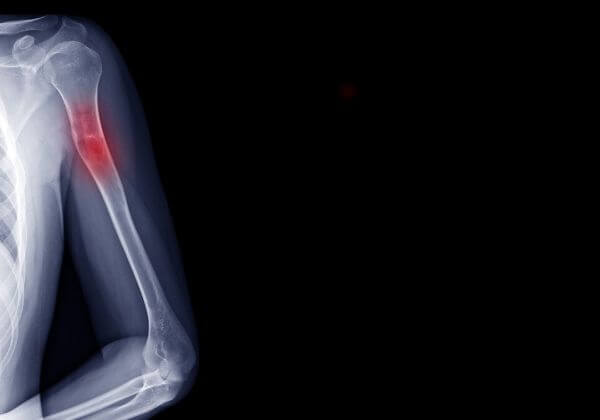 Bone Cysts: Causes, Types, and Outlook