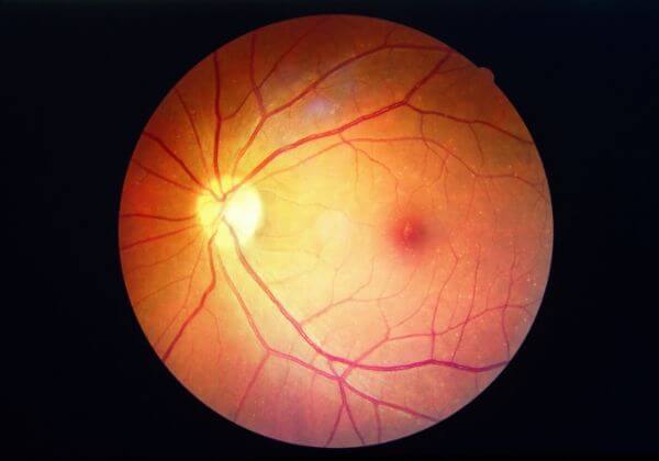 Diabetic Retinopathy: Causes, Treatments, and Long-Term Outlook