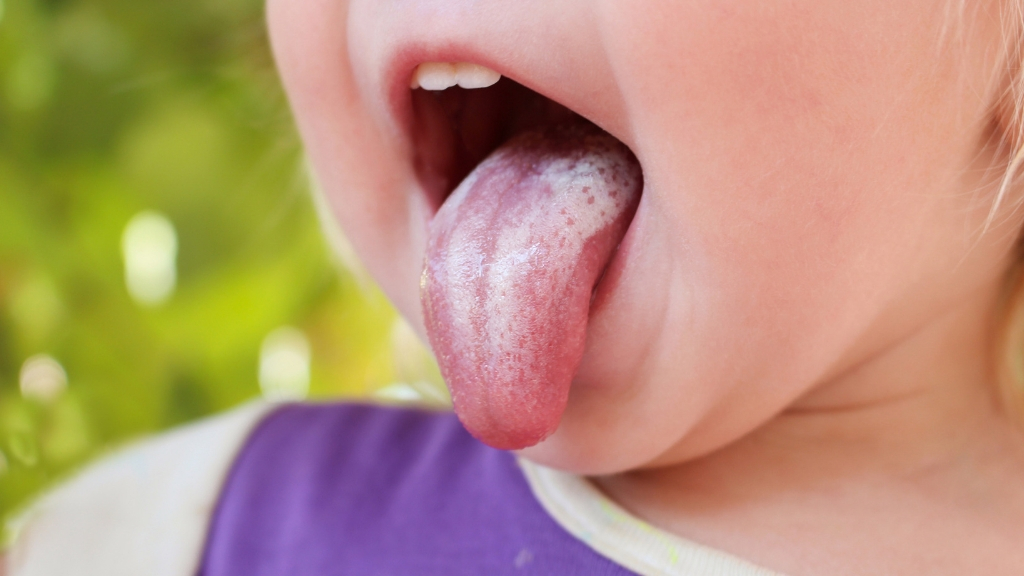 Oral thrush in kid's mouth