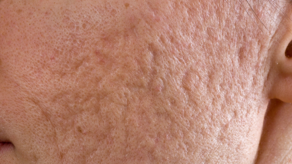 vitamin a deficiency skin bumps