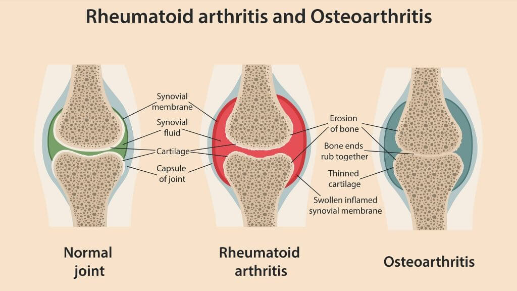 Rheumatoid arthritis and osteoarthritis