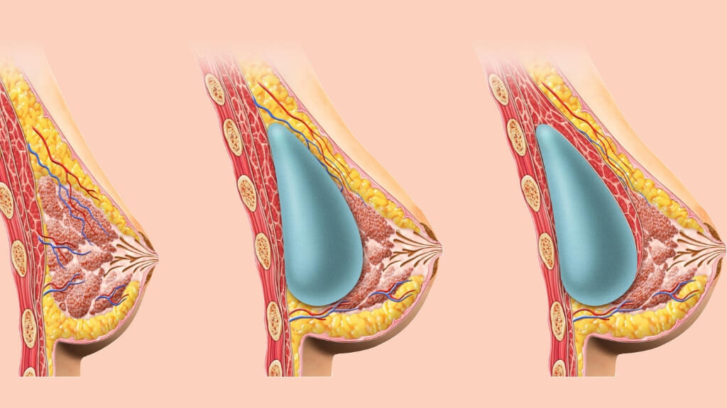 implants cancer breast link silicone 1md should feel between