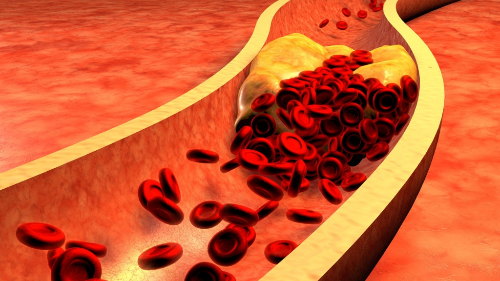 Свободные сосуды. Сердце с огромным холестерином. Холестерин фото реальное. Сердце покрытое холестерином.