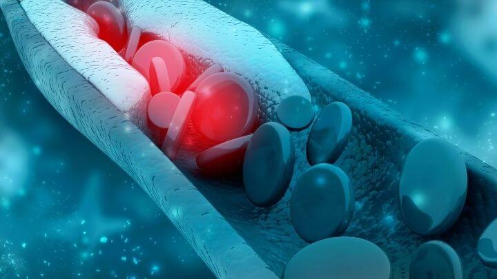 An artery clogged with cholesterol