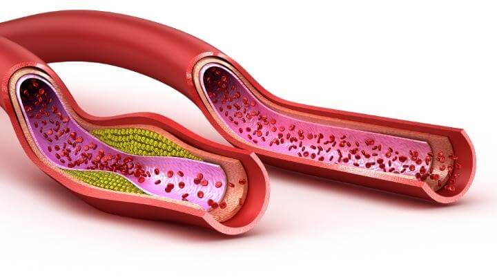 Vein with cholesterol vs clear vein 