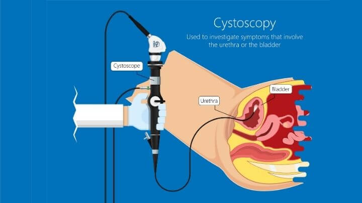 Cystoscopy