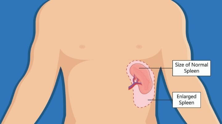 Enlarged Spleen