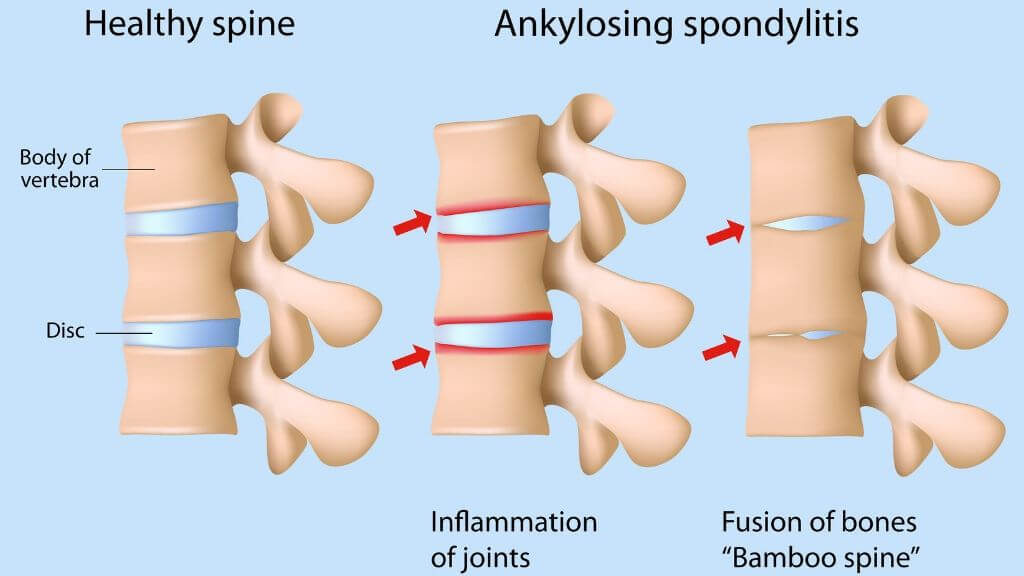 Спондилит. Анкилозирующий спондилит позвоночника. Анкилозирующий артрит. Анкилозирующий спондилит артрит. Ревматоидный спондилит.