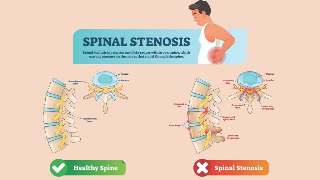 Spinal Stenosis Symptoms Diagnosis And Variations 1md Nutrition 7233