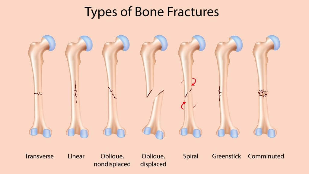 Bone Fracture: Causes, Types of Fractures, and Outlook | 1MD