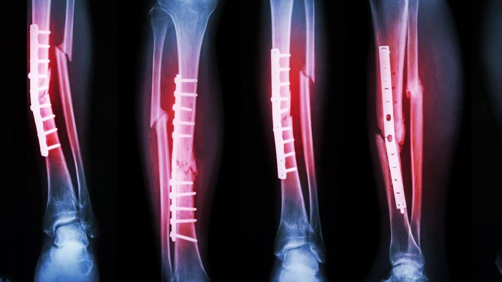 Bone Fracture: Causes, Types of Fractures, and Outlook | 1MD