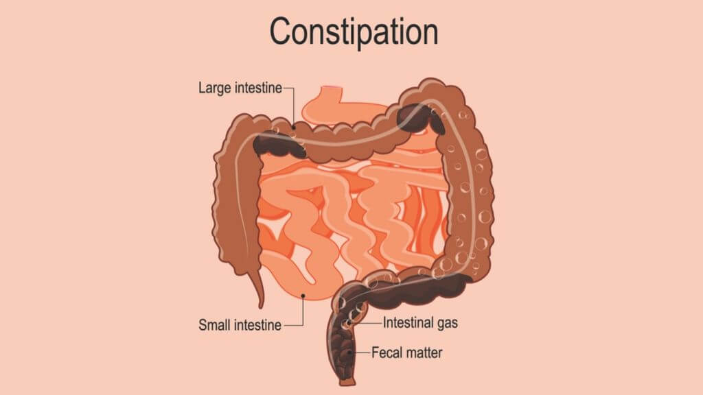 Constipation 2 