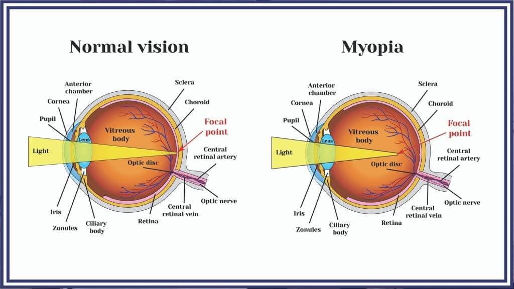 what is the cause of refractive error