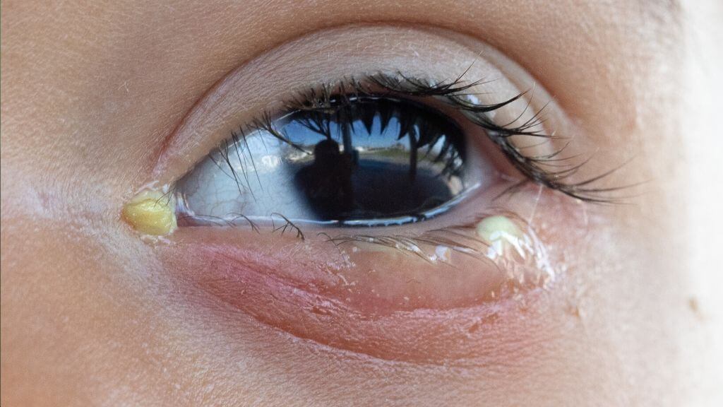 Eye Discharge: Causes, Associated Conditions, and Treatments | 1MD ...