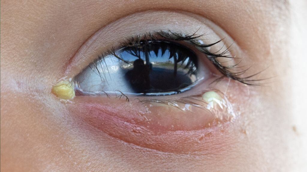 Allergies Causing Yellow Eye Discharge