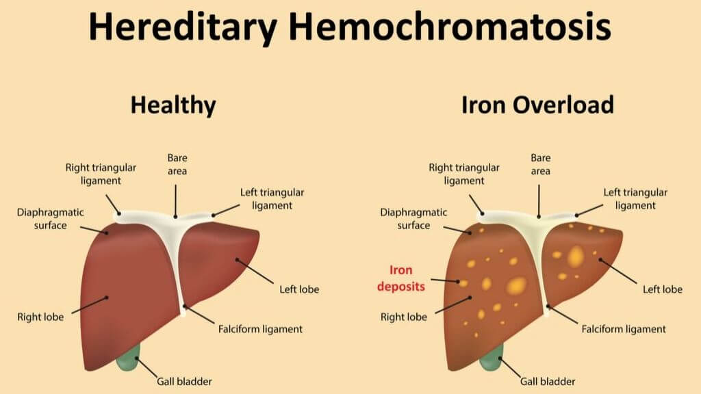 Hemochromatosis: Symptoms, Treatment, and Long-Term Outlook | 1MD ...