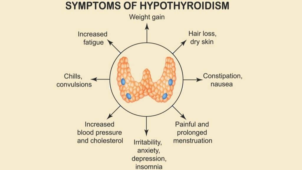 Hypothyroidism symptoms