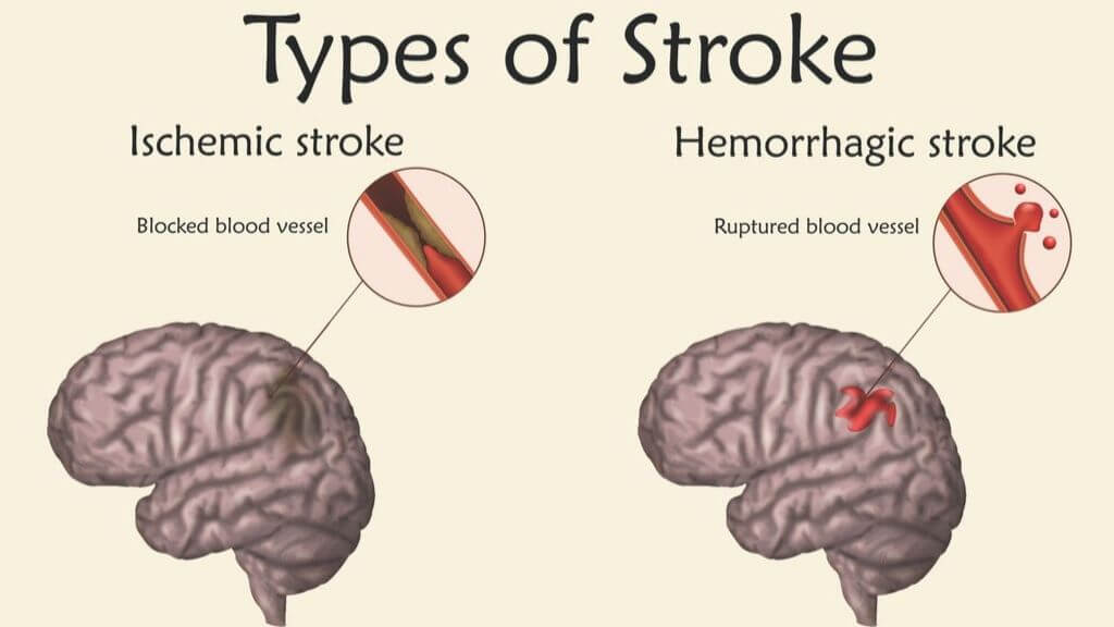 Stroke: Types, Symptoms, and Long-Term Outlook | 1MD Nutrition™