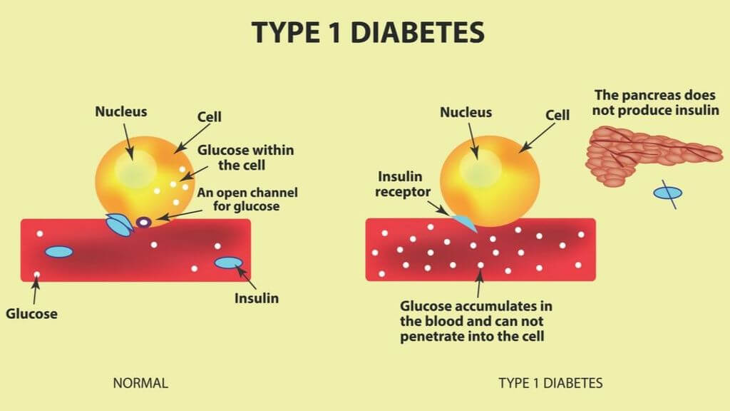 type 1 diabetes cause)