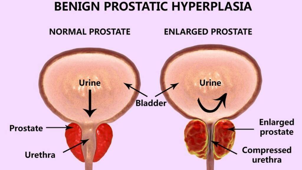 Benign Prostatic Hyperplasia is a Prostate Gland Enlargement