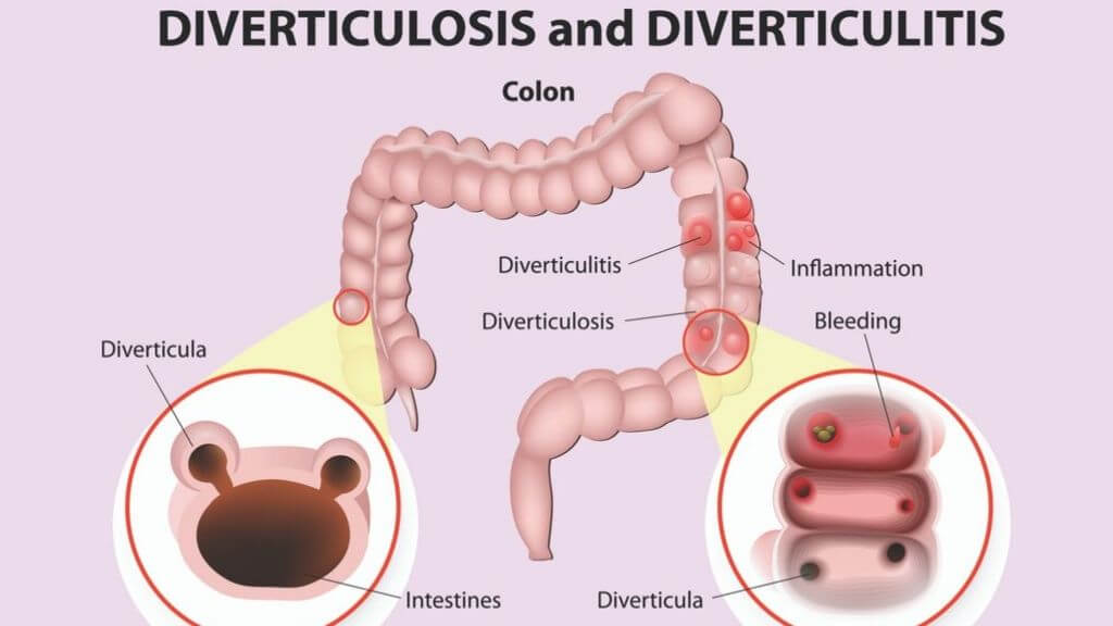 Diverticulosis and Diverticulitis