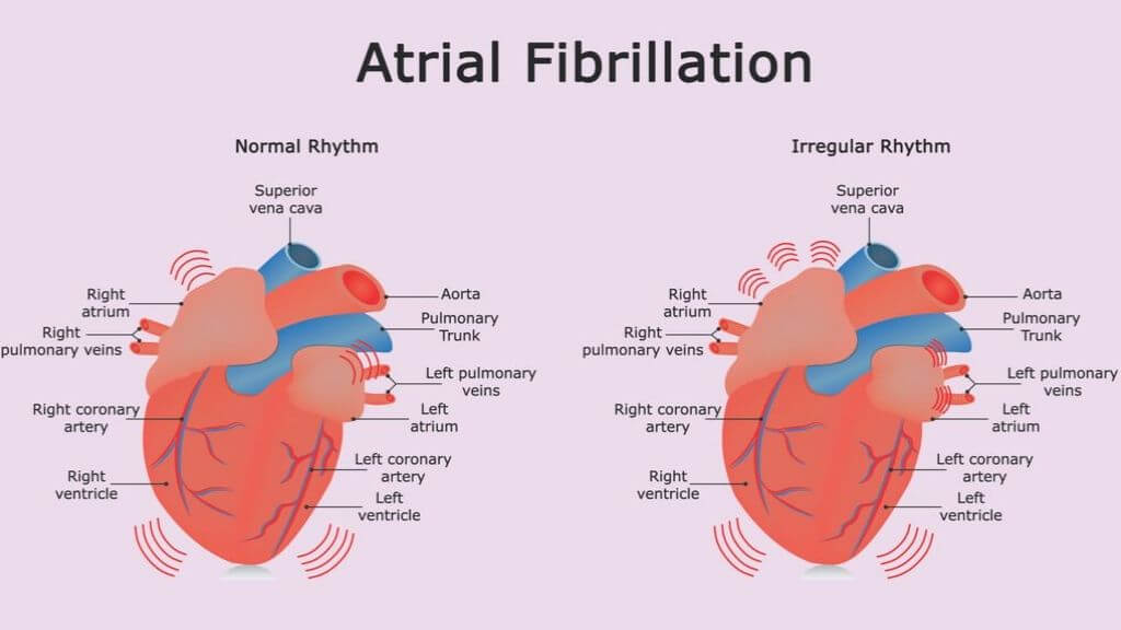 irregular heartbeat causes in adults