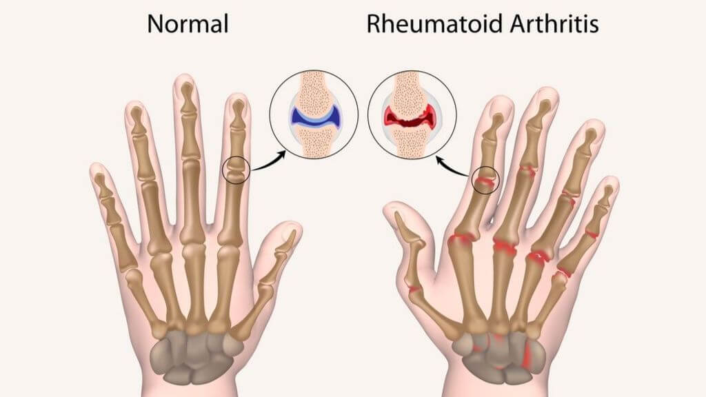 Causes and Natural Remedies for Rheumatoid Arthritis Linked to Poor ...