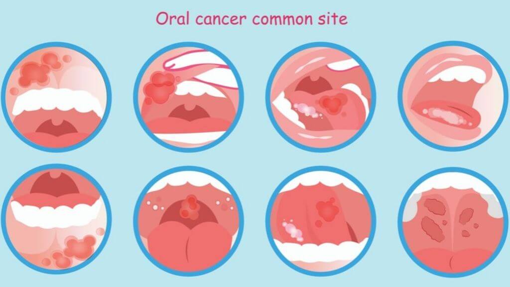 Can A Tongue Piercing Cause A Sore Throat