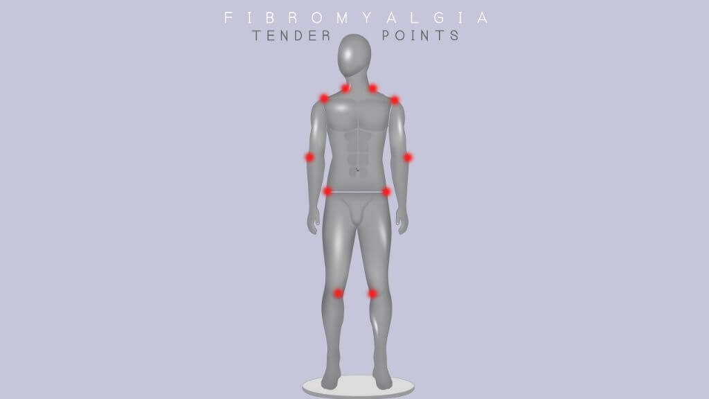 Fibromyalgia Tender Points