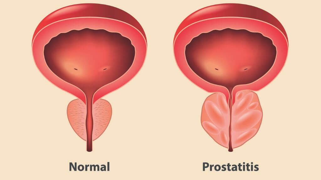 Trouble Urinating Causes Diagnosis And When To See Your Doctor 1md Nutrition™