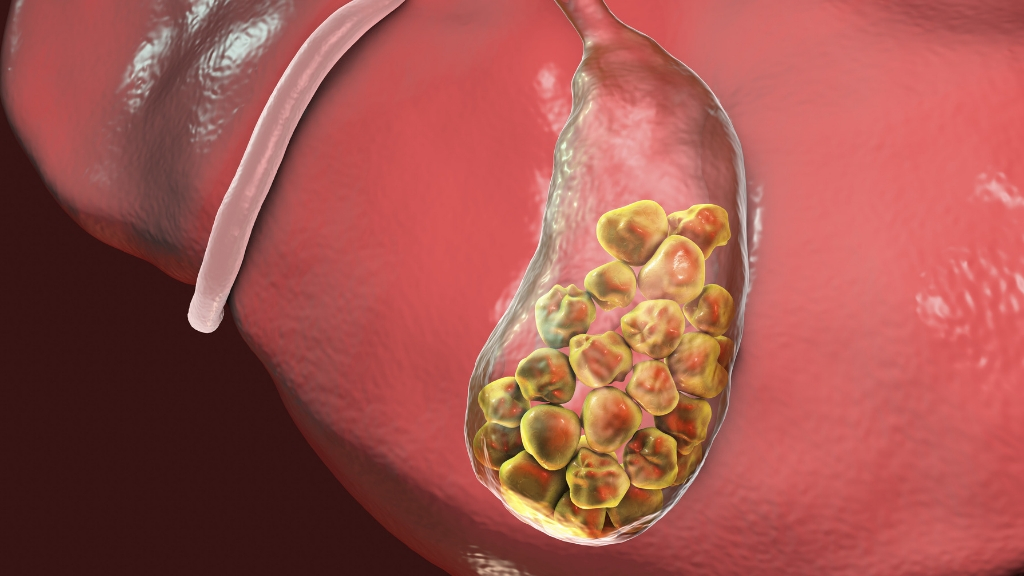 How to Spot if You Have a Gallbladder Problem Signs and Symptoms 1MD