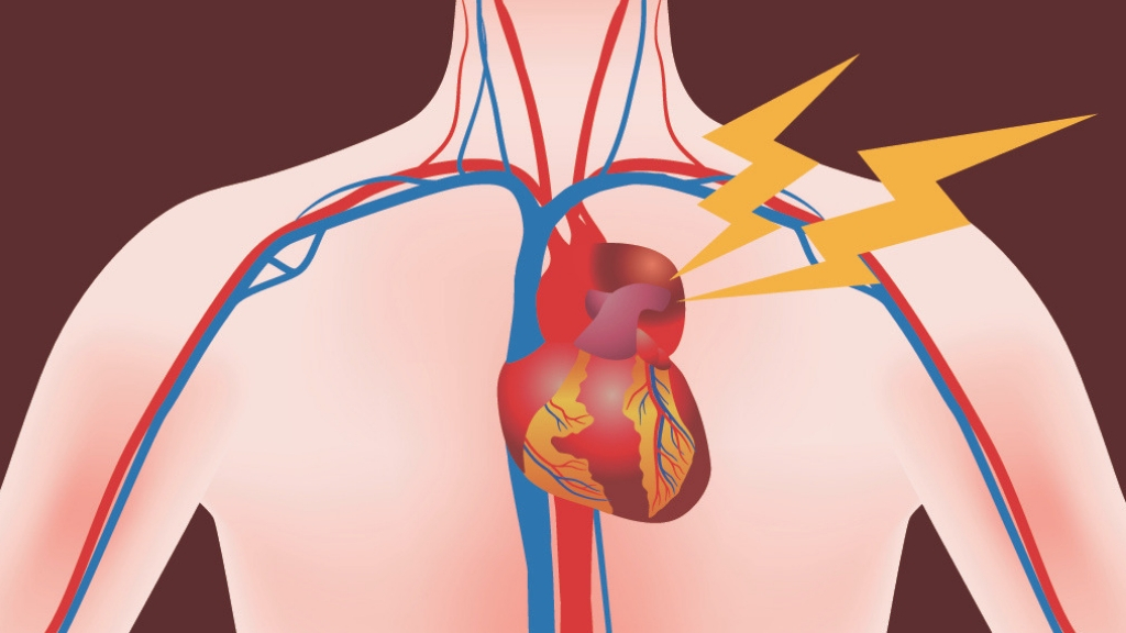 Тромбоз аорты симптомы. D Aorta Flow. Оторвался тромб в легких