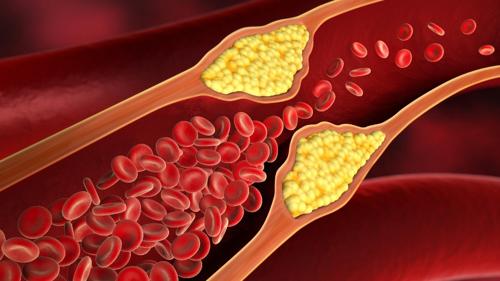 How Omega3s Can Lower Cholesterol & Reduce Triglycerides—Heart Health