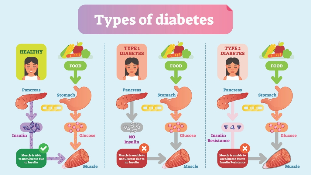 what is the most common form of diabetes