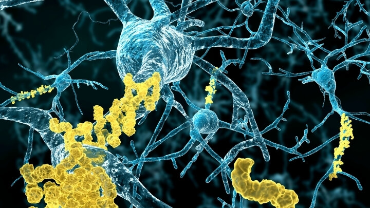 Neurons with amyloid plaques