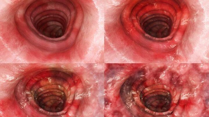 Ulcerative colitis stages