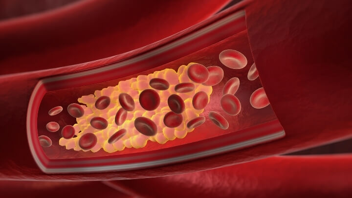 Illustration of cholesterol build up in a vein