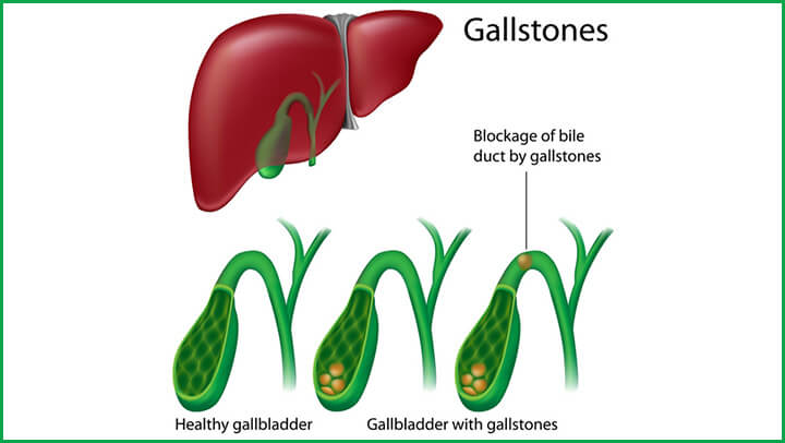 Gallstones